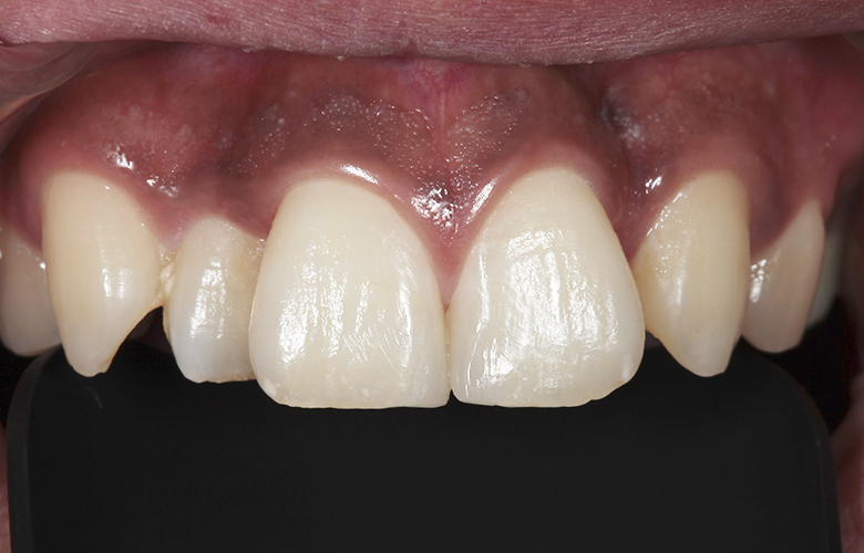 千葉県茂原市の歯医者、たけ歯科クリニックのマイクロスコープ精密治療