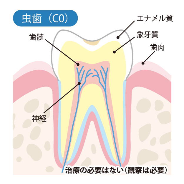 千葉県茂原市の歯医者、たけ歯科クリニックのむし歯治療