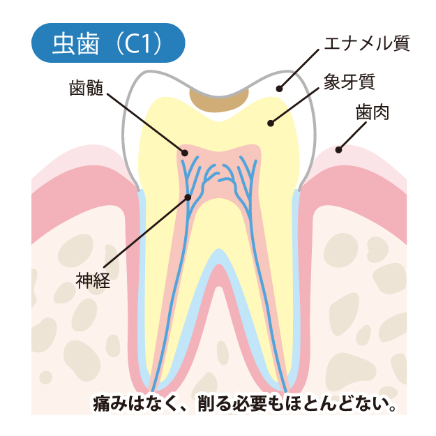 千葉県茂原市の歯医者、たけ歯科クリニックのむし歯治療