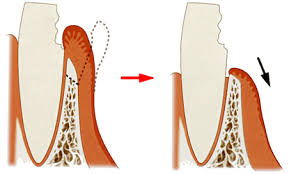 千葉県茂原市の歯医者、たけ歯科クリニックのなるべく削らず、歯を守る治療