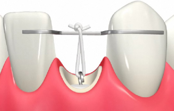 千葉県茂原市の歯医者、たけ歯科クリニックのなるべく削らず、歯を守る治療