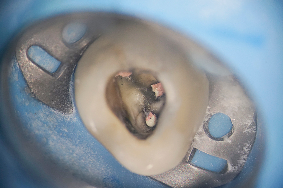 千葉県茂原市の歯医者、たけ歯科クリニックの根管治療