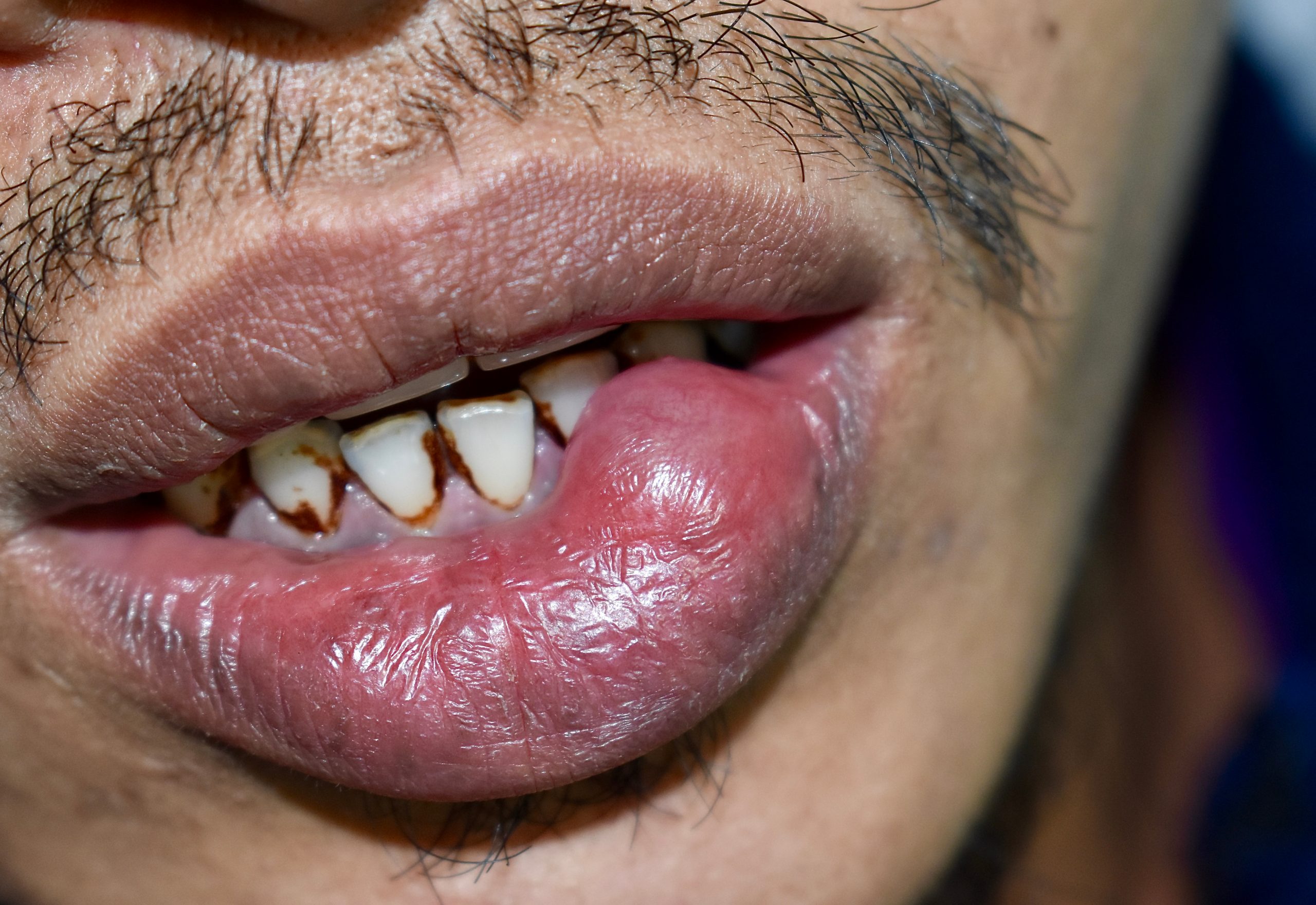 茗荷谷駅徒歩2分の歯医者｜佐藤歯科医院のお口の中のデキモノ